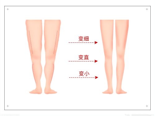 未成年人能通过手术矫正腿型吗 矫正腿型的方法有几种呢